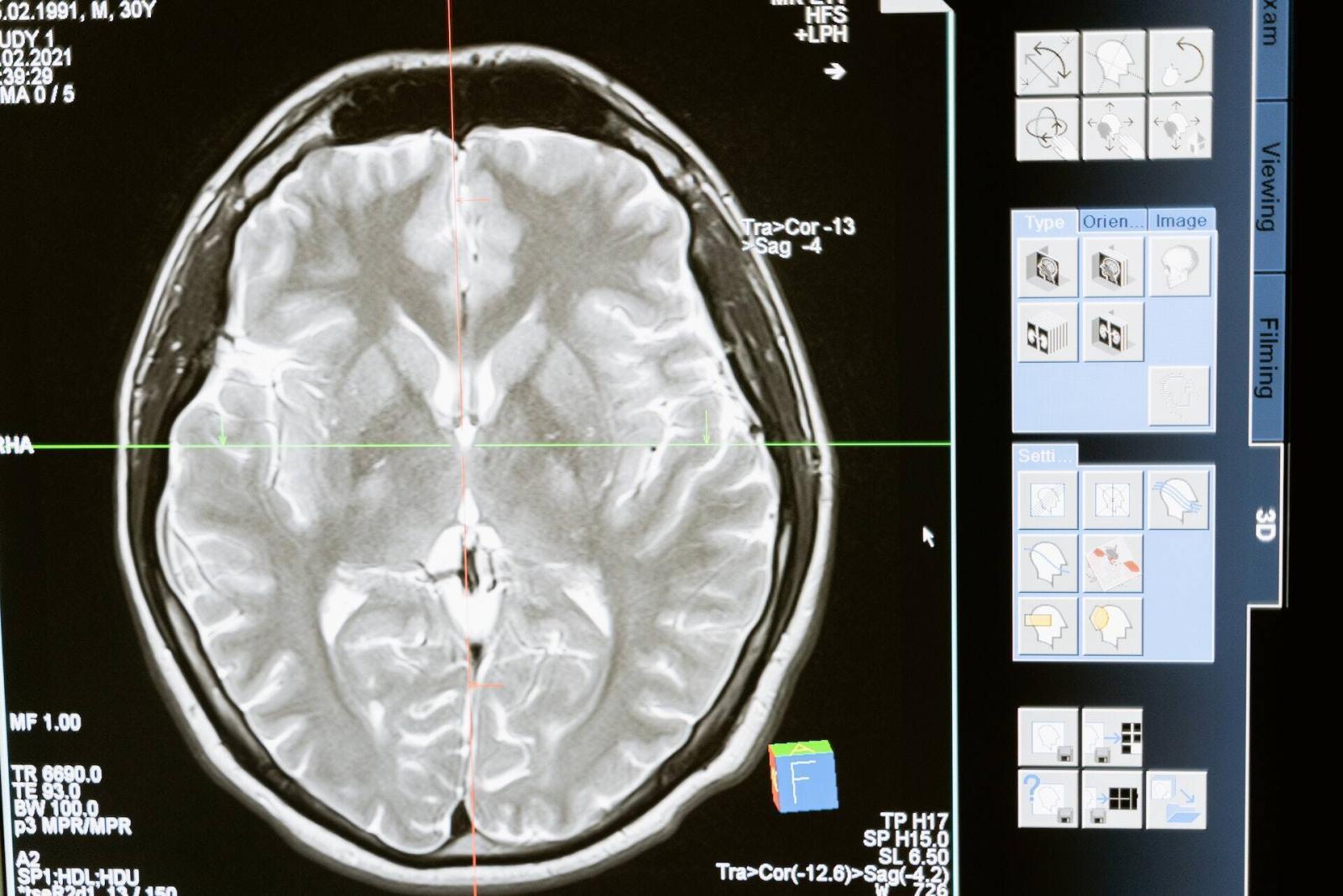 radio cerveau